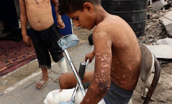 El niño palestino Zain Al-Anqar resultó herido por la explosión de un sospechoso resto de guerra en Gaza.